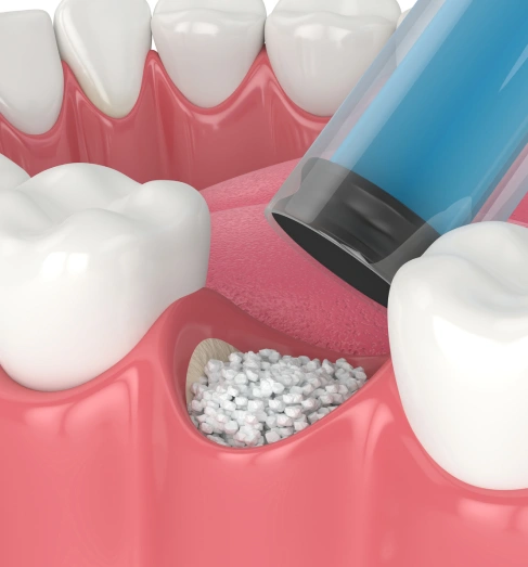 img-Restoring-Smiles-with-Bone-Grafting-and-Reconstruction